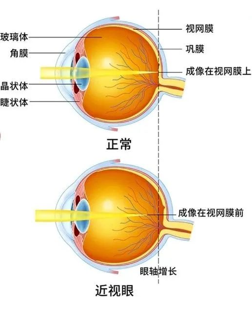 户外近视防控的那些事儿合肥普瑞眼科：你真的了解吗？米乐M6 M6米乐